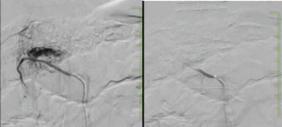 Figure 3: (a and b) depicts the pre-embolization and post-embolization status of the hemangiomatous lesion involving the D12 vertebra.