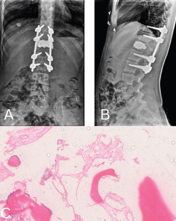 Figure 4: (a and b) Post-operative day 2 Anteroposterior and Lateral view x-rays showing post-vertebroplasty status at D12 and posterior spine fixation from D10 to L2. (c) Histopathological examination revealed a vascular neoplasm composed of compact, thin-walled vascular channels of varying sizes separated by stroma. Endothelial cells showed mild nuclear enlargement and atypia, without mitotic activity or necrosis.
