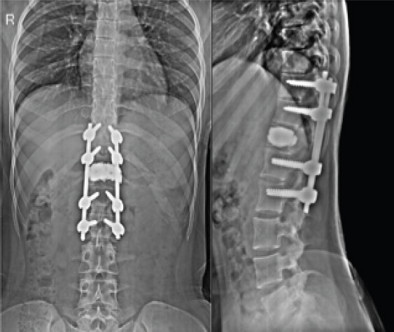 Figure 5: (a and b) Post 5 years – anteroposterior and lateral view radiographs showing good spinal alignment and well-positioned implants.