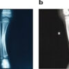 Angular Improvement with Bracing Over 7 Years in Anterolateral Tibial Bowing without Neurofibromatosis Type 1: A Case Report