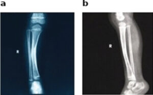 Figure 1: Anteroposterior and lateral radiographs of the right tibia and fibula. Anteroposterior (a) and lateral (b) radiographs of the right tibia and fibula obtained in 2021, at approximately 4 years of age, demonstrating anterolateral bowing of the tibia at the mid-diaphysis without fracture. The characteristic anterior and lateral curvature is present with a patent medullary canal, without hourglass tapering, cystic change, or cortical breach, corresponding to Paley type 1.