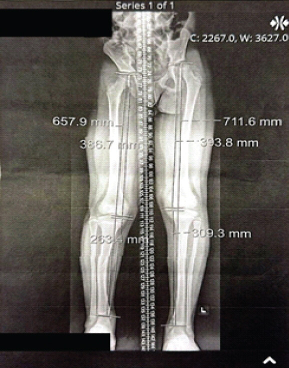 Figure 2: Standing lower extremity scanogram after more than 7 years of bracing. Standing anteroposterior scanogram of both lower extremities obtained in February 2026, after more than 7 years of total contact orthosis and shoe-lift treatment, demonstrating improvement in tibial bowing on the right together with the residual limb length discrepancy. Segmental measurements are displayed on the image. Bone density is normal and there is no fracture. Patient identifiers have been removed from the image.