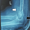 Capitellum Fracture with Distal Triceps Tendon Avulsion Injury: A Rare Presentation with Literature Review