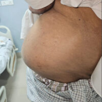 Figure 1: Clinical picture of the right lumbar hernia.