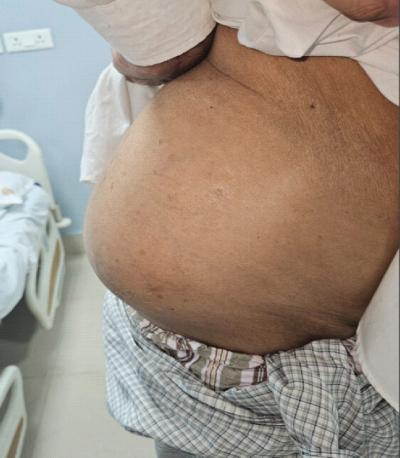 Figure 1: Clinical picture of the right lumbar hernia.