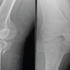 Tibial Plateau Fracture in a Patient with Fibular Hemimelia: A Case Report