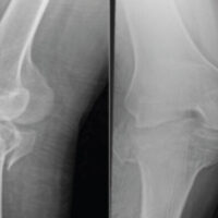 Figure 1: Right knee and tibia radiographs (anteroposterior and lateral views) obtained at initial presentation (day 0 post-injury) show a comminuted bicondylar tibial plateau fracture with intra-articular extension and joint effusion.