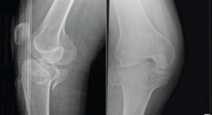 Figure 1: Right knee and tibia radiographs (anteroposterior and lateral views) obtained at initial presentation (day 0 post-injury) show a comminuted bicondylar tibial plateau fracture with intra-articular extension and joint effusion.