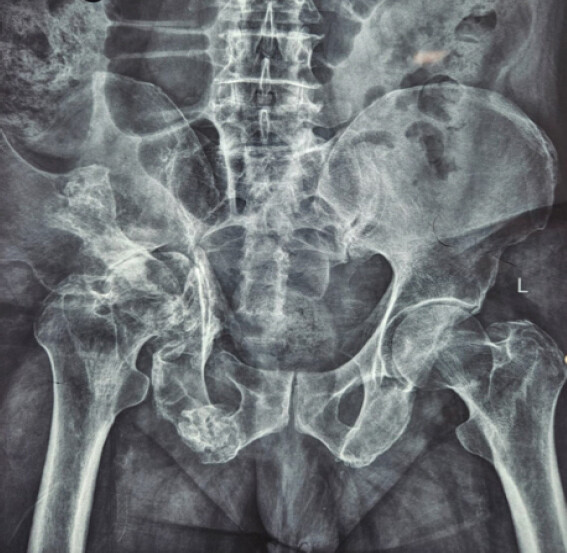 Figure 2: Pre-operative AP pelvic radiograph demonstrating chronic right iliac wing malunion with marked pelvic asymmetry and protrusio acetabuli.