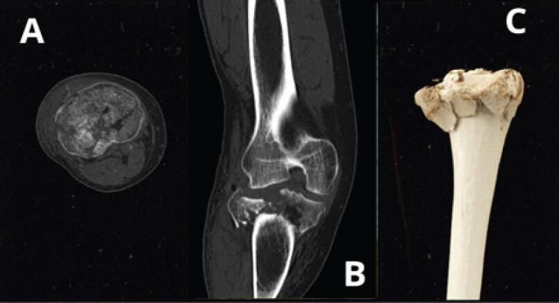 Figure 2: Pre-operative computed tomography imaging demonstrating multifragmentary articular comminution and congenital absence of the fibula. (a) Axial view showing bicondylar fracture pattern with articular depression. (b) Sagittal view demonstrating posterior fragment displacement. (c) Three-dimensional reconstruction showing the extent of comminution and absent fibula.