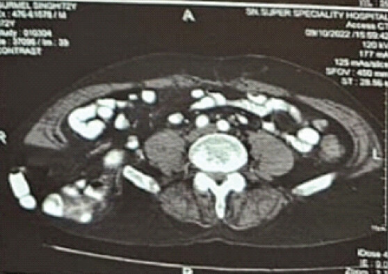 Figure 3: Axial computed tomography scan demonstrating a right lumbar hernia with herniation of retroperitoneal fat through a posterior fascial defect.