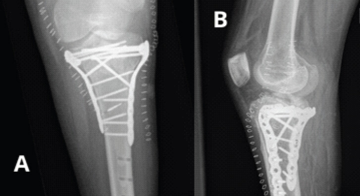 Figure 3: Immediate post-operative radiographs following open reduction and internal fixation. (a) Anteroposterior view demonstrating dual-plate fixation. (b) Lateral view demonstrating hardware position and articular reduction. Note the absence of the fibula on the lateral view, consistent with the underlying fibular hemimelia.