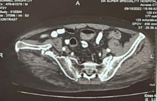 Figure 4: Axial computed tomography scan demonstrating the chronic right iliac wing malunion with cortical sclerosis, periosteal reaction, and bony deformity.