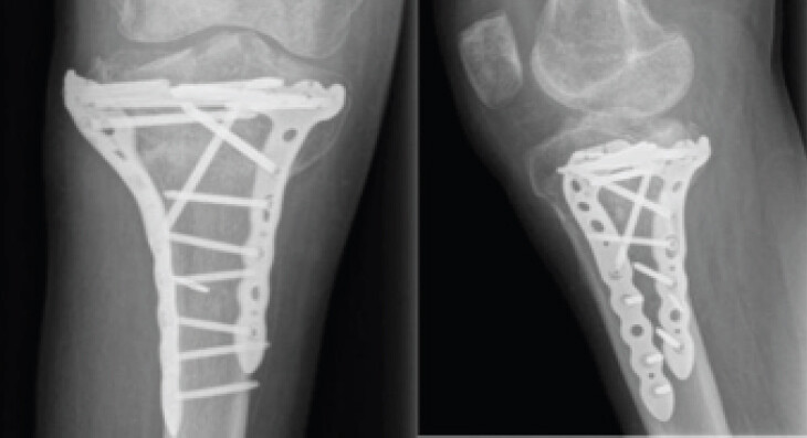 Figure 4: Follow-up radiograph taken at 5 months after injury shows ongoing fracture healing with stable fixation.