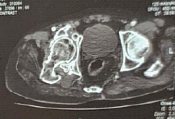 Figure 5: Axial computed tomography scan demonstrating medial migration of the right femoral head beyond the ilioischial line.
