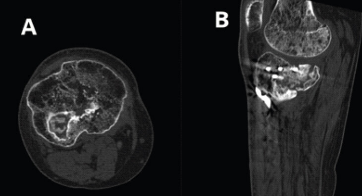 Figure 5: Computed tomography imaging at 5 months demonstrating delayed union of the posteromedial tibial plateau fragment. Axial and sagittal views showing a persistent fracture gap without bridging callus, with hardware in situ.