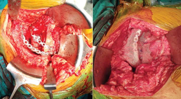 Figure 6: Intraoperative photographs. Left: Primary polypropylene mesh placement and placement of dual reconstruction plates. Right: Secondary mesh placement over the dual 3.5 mm reconstruction plates along the iliac blade.