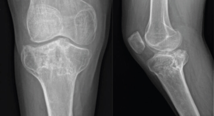 Figure 6: Anteroposterior and lateral radiograph of the right knee after removal of internal fixation hardware.