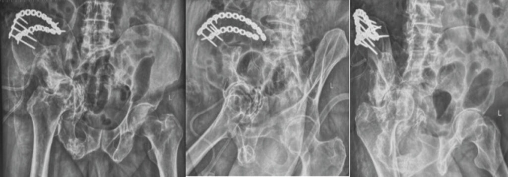 Figure 7: Immediate post-operative radiographs (AP pelvis and Judet views).