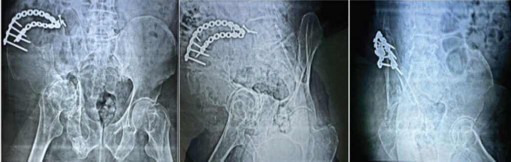 Figure 8: Twelve-month follow-up radiographs (AP pelvis and Judet views).