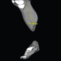 Figure 1: Longitudinal reformat of non-contrast computed tomography (CT) of the left leg. Longitudinal CT reformat obtained at the second presentation, showing the cranio-caudal extent of the intramuscular hematoma, measuring 17.39 cm.