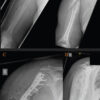 Humeral Fractures in Metabolically Compromised Bone: Outcomes of Structural Strut Onlay Allograft with Open Reduction and Internal Fixation – A Case Series of Three Patients