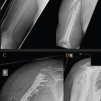 Figure 1: Case 1. (a and b) Pre-operative plain radiographs. (a) Anteroposterior view demonstrating fracture shaft humerus. (b) Hypertrophic non-union following conservative treatment. (c and d) (c) Post-operative radiograph demonstrating satisfactory locking plate position with allograft strut at the non-union site. (d) 1-year follow-up confirming complete strut incorporation and solid bony union.