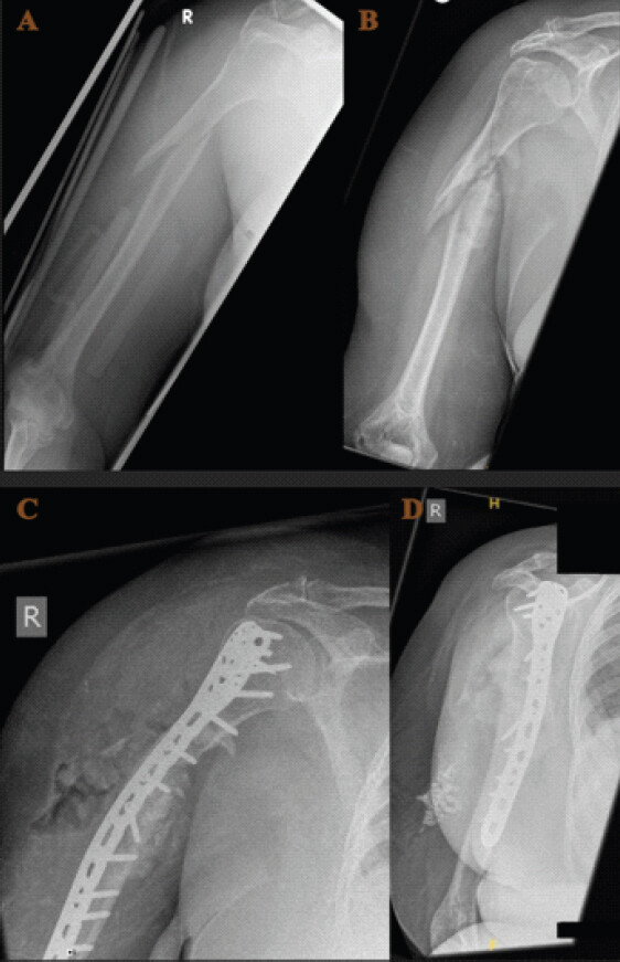 Figure 1: Case 1. (a and b) Pre-operative plain radiographs. (a) Anteroposterior view demonstrating fracture shaft humerus. (b) Hypertrophic non-union following conservative treatment. (c and d) (c) Post-operative radiograph demonstrating satisfactory locking plate position with allograft strut at the non-union site. (d) 1-year follow-up confirming complete strut incorporation and solid bony union.