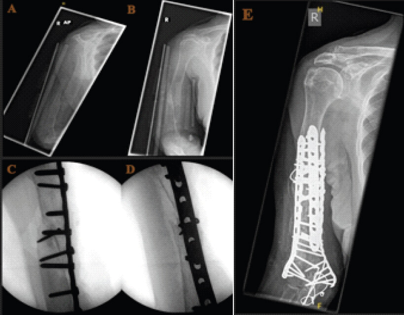 Figure 2: Case 2. a and b: Pre-operative plain radiographs. (a) AP view demonstrating atrophic non-union with cortical loss and osteopenia at the humeral shaft. (b) Lateral view confirming the non-union configuration and degree of shortening. (c and d) Intraoperative image intensifier views demonstrating the locking plate construct prior to strut graft supplementation. They illustrate screw trajectory and plate position. Note the osteoporotic cortical thinning visible on both projections. (e) Final construct following addition of supplementary double condylar locked plates and cerclage wires around the allograft strut, confirming a mechanically robust fixation assembly.