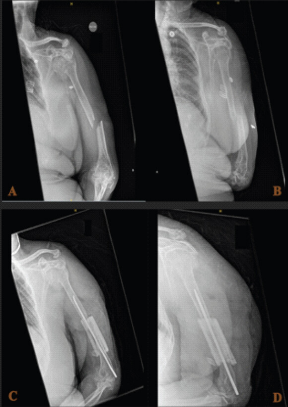 Figure 3: Case 3. (a and b) Pre-operative plain radiographs of the left humerus. (a) anteroposterior (AP) view demonstrating an angulated displaced distal third humerus fracture. (b) Lateral/oblique view confirming the fracture pattern. (c and d) Post-operative plain radiographs. (c) AP view demonstrating TEN nail trajectory from distal to proximal within the humeral shaft. The allograft strut (radio-opaque cylinder alongside the nail) provides supplementary cortical support. (d) Lateral view demonstrating the fixation construct spanning the distal third fracture site; pre-existing arthritic changes at the elbow joint are visible.