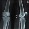 Popliteal Artery Aneurysm in a Young Intravenous Drug User: A Case Report
