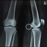 Figure 1: Anteroposterior and lateral X-ray views of the left knee showing needle in lateral view.