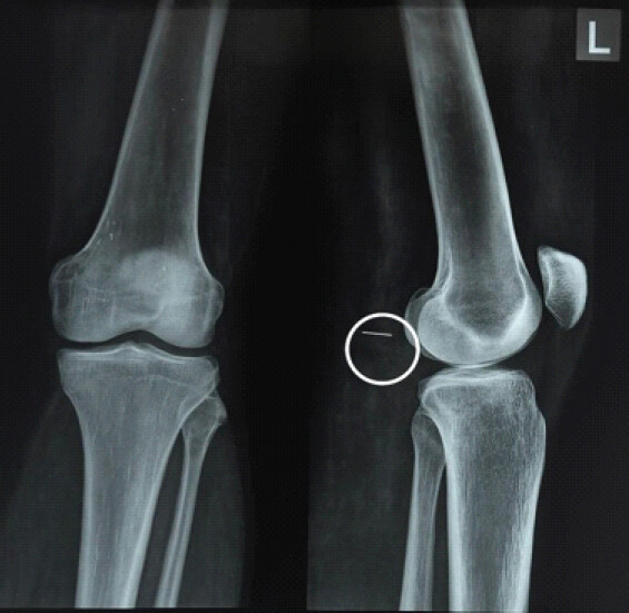 Figure 1: Anteroposterior and lateral X-ray views of the left knee showing needle in lateral view.