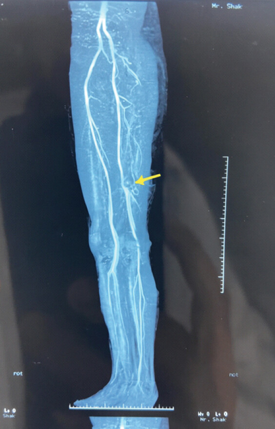 Figure 2: Computed tomography angiography of the left knee region showing a large popliteal artery aneurysm (arrow) with contrast extravasation and adjacent hematoma in the popliteal fossa.