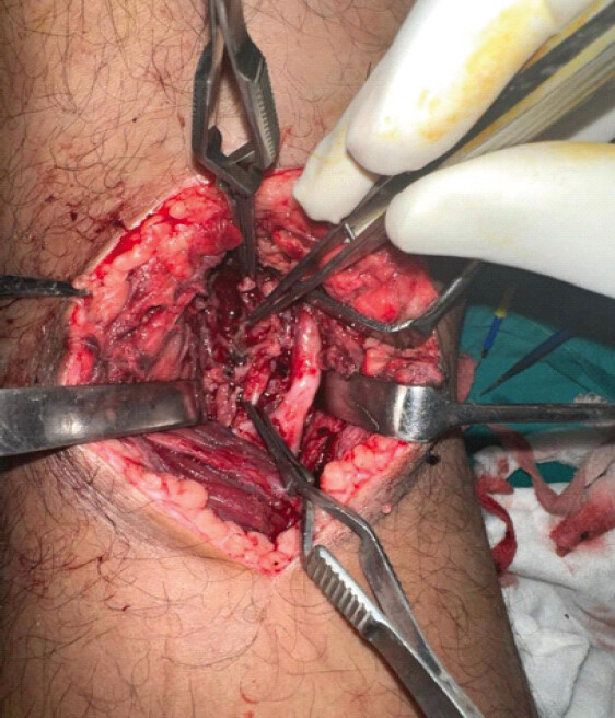 Figure 3: Intraoperative vascular reconstruction – Surgical exposure through a posterior approach revealing the aneurysmal sac and the site of focal wall rupture.