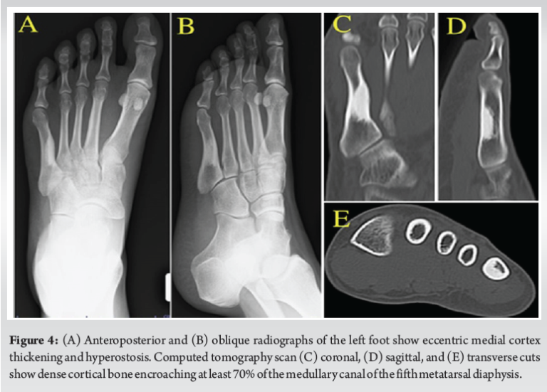melorheostosis-two-case-reports-and-review-of-current-literature