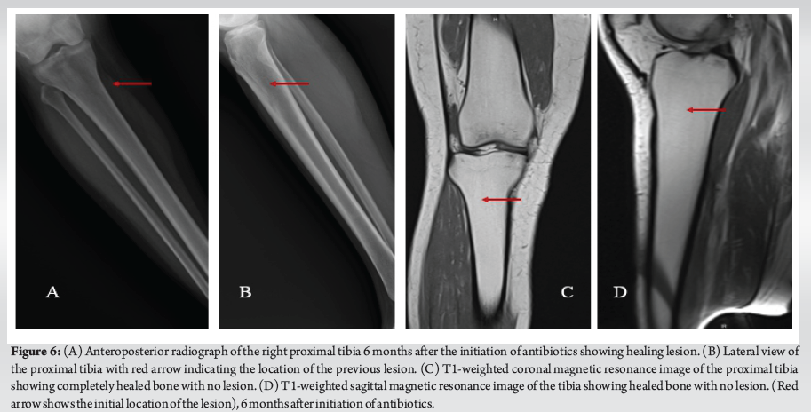 Ipsilateral Tibia Subacute Bifocal Salmonella Osteomyelitis of the Mid Shaft of Femur and ...