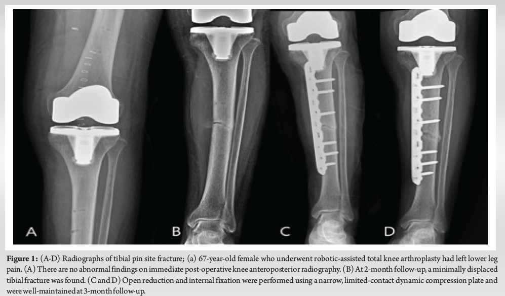 Tracking Pin Site Fractures And Measures To Overcome During Robotic 