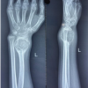 A Novel, Joint Sparing Surgical Approach to the Management of Giant Cell Tumor of the Distal Radius in a Pediatric Patient: A Case Report and Comprehensive Literature Review