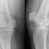 Early Post-operative Fracture of Titanium Cementless Tibial Baseplate: Case Report and Review of the Literature