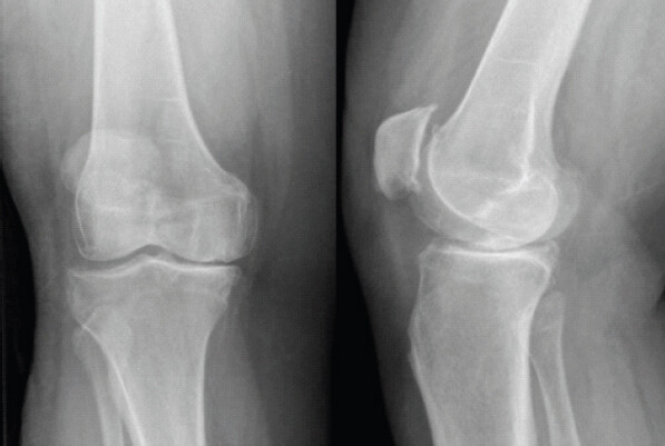 Figure 1: Pre-operative anteroposterior and lateral radiographs of the right knee obtained 1 month before the patient undergoing total knee arthroplasty.