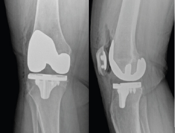 Figure 2: Immediate post-operative Anteroposterior and lateral radiographs of the right knee following cementless total knee arthroplasty (Triathlon Tritanium, Stryker Orthopaedics).