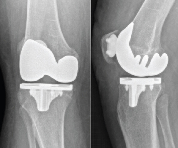 Figure 3: One-month post-operative anteroposterior and lateral radiographs of the right knee following report of increasing pain.