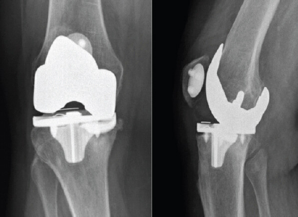Figure 4: Anteroposterior and lateral radiographs taken on presentation to clinic demonstrating fracture of the tibial baseplate and extruded polyethylene insert.