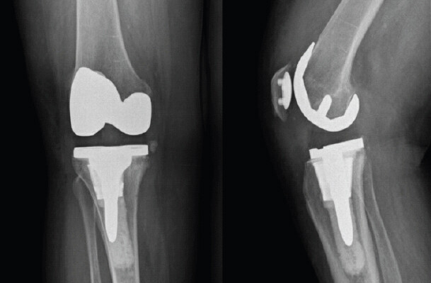 Figure 5: Anteroposterior and lateral radiographs taken post-operatively demonstrating revision of tibial baseplate with retention of femoral and patellar components.