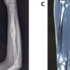Osteoblastoma of the Radial Shaft Mimicking Parosteal Osteosarcoma: A Case Report