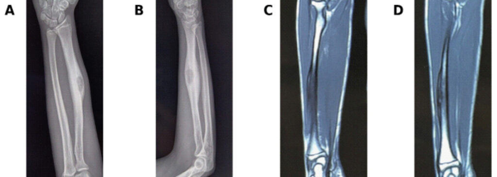 Figure 1: Pre-operative radiological evaluation of radial shaft lesion. (a and b) Pre-operative anteroposterior and lateral radiographs of the right forearm demonstrating an expansile surface-based lesion involving the middle third of the radial shaft, associated with cortical thickening and periosteal reaction. (c and d) Coronal magnetic resonance imaging demonstrating cortical involvement with adjacent soft-tissue extension along the radial shaft. The clinicoradiological appearance raised suspicion for a surface osteogenic malignancy, and subsequent biopsy was suggestive of parosteal osteosarcoma.