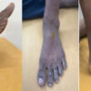 Unnoticed Giant Cell Tumor of the Left Distal Tibia in a 52-Year-Old Male: A Rare Case Report