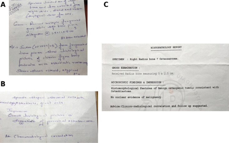 Figure 2: Histopathological diagnostic discrepancy between biopsy and final specimen. (a and b) Pre-operative biopsy reports demonstrating histological findings suggestive of parosteal osteosarcoma and advising clinicoradiological correlation. (c) Final histopathological examination of the excised specimen demonstrating histomorphological features of osteoblastoma with no nuclear evidence of malignancy, confirming the benign nature of the lesion.
