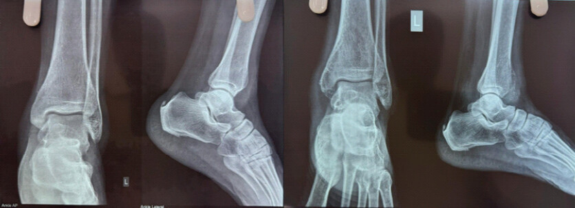 Figure 2: 1st X-ray showing mild cortical thinning taken in February 2024 and 2nd X-ray showing Soap bubble appearance in the distal end of the tibia taken in October 2024.